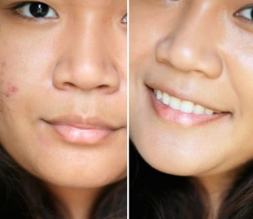 how-to-get-rid-of-acne-scars-840x480